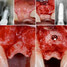 Vertical and Horizontal Bone Augmentation in the Aesthetic Zone