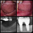 Vertical Bone Augmentation of the Posterior Mandible