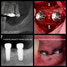 Vertical Bone Augmentation of the Posterior Mandible