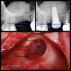 Lateral Sinus Augmentation and immidiate Implant Placement
