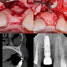 Horizontal Bone Augmentation of Congenitally Misssing Lateral