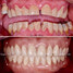 Implant Supported Prosthese for a Medically Compromized Patient