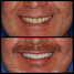 Full mouth Rehabilitation with Implant supported Prostheses  