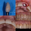 Immediate Implant Placement and Temporization 